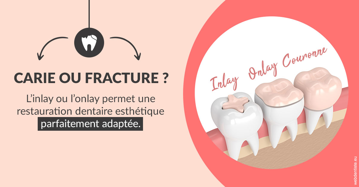 https://dr-guillemant-hubert.chirurgiens-dentistes.fr/T2 2023 - Carie ou fracture 2