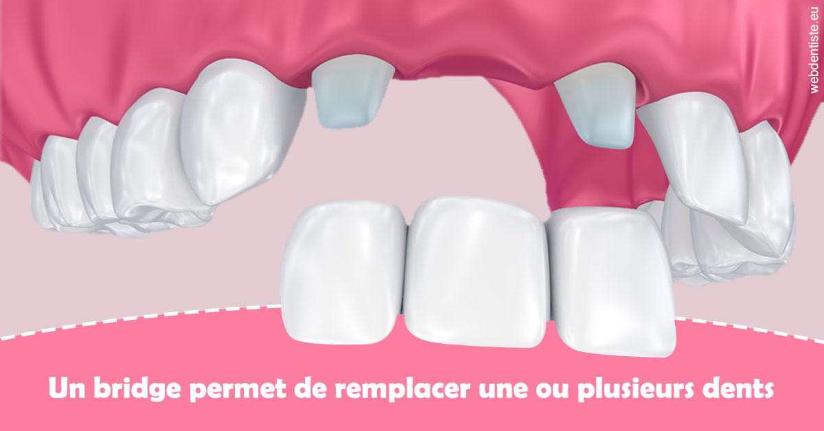 https://dr-guillemant-hubert.chirurgiens-dentistes.fr/Bridge remplacer dents 2