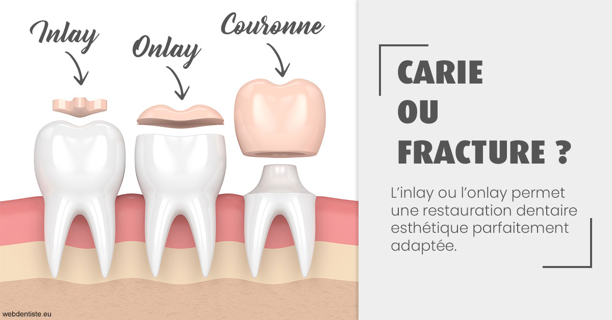 https://dr-guillemant-hubert.chirurgiens-dentistes.fr/T2 2023 - Carie ou fracture 1
