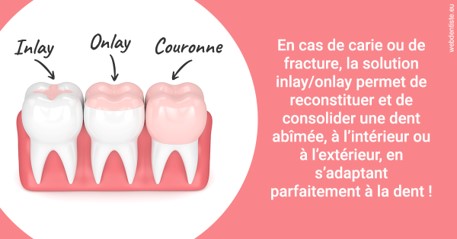 https://dr-guillemant-hubert.chirurgiens-dentistes.fr/L'INLAY ou l'ONLAY 2