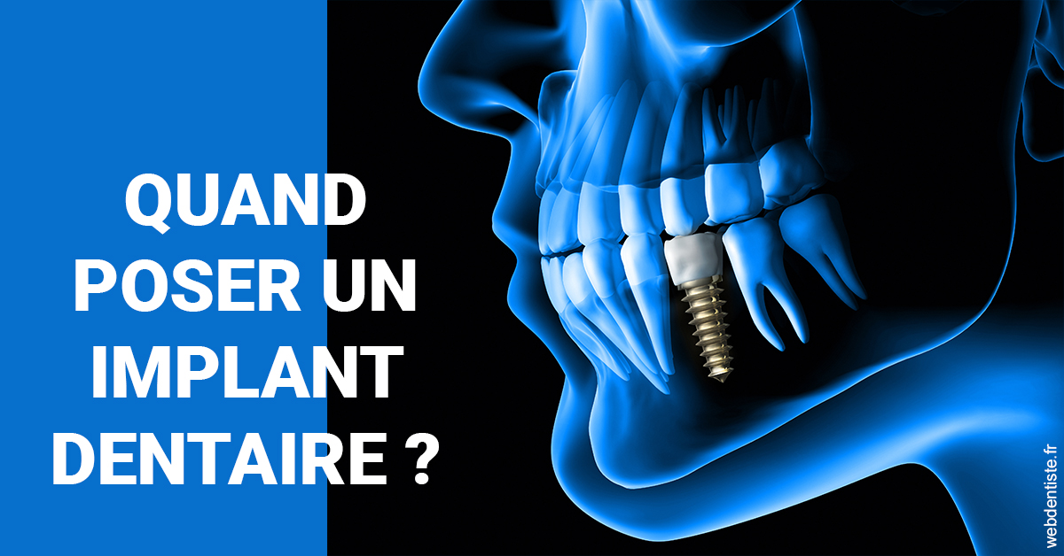 https://dr-guillemant-hubert.chirurgiens-dentistes.fr/Les implants 1