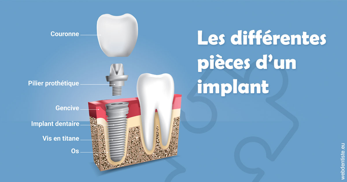 https://dr-guillemant-hubert.chirurgiens-dentistes.fr/Les différentes pièces d’un implant 1